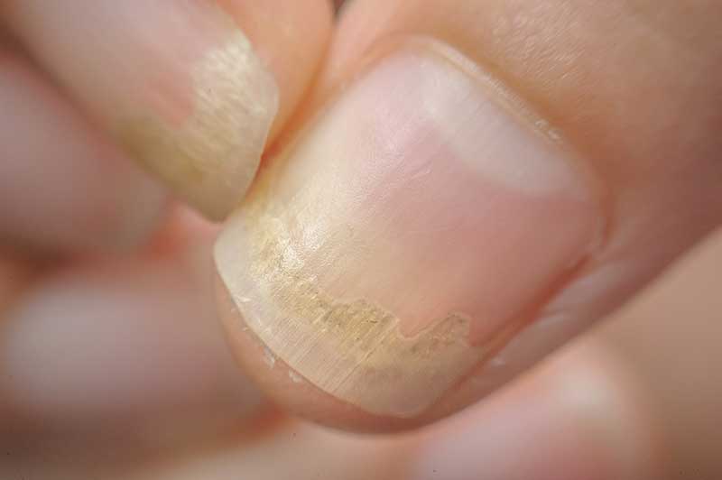 What Your Nails Say About Your Health, Fingernail & Toenail Health