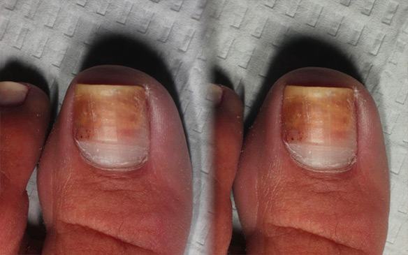 Fingernail Fungus, Nail Health, Treatment & Symptoms