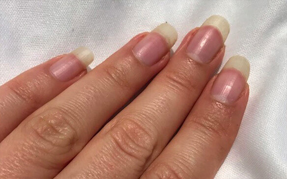 Is Coconut Oil Good For Your Nails & Nail Infections