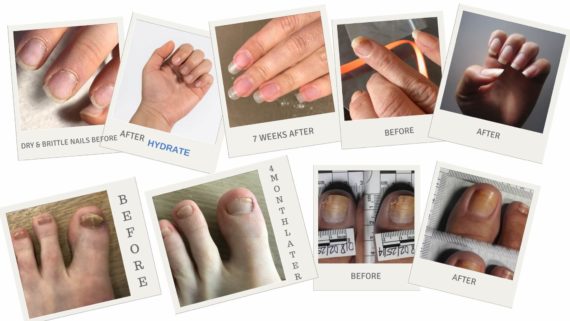 is-nail-fungus-contagious-preventing-toenail-fingernail-fungus