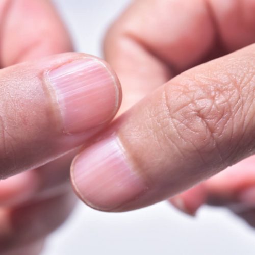 Nail Ridges Treatment | Fingernail Ridges Treatment | Drs. Kline + Green™
