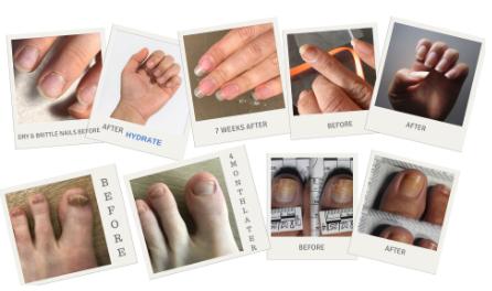 Is Nail Fungus Contagious? Preventing Toenail & Fingernail Fungus