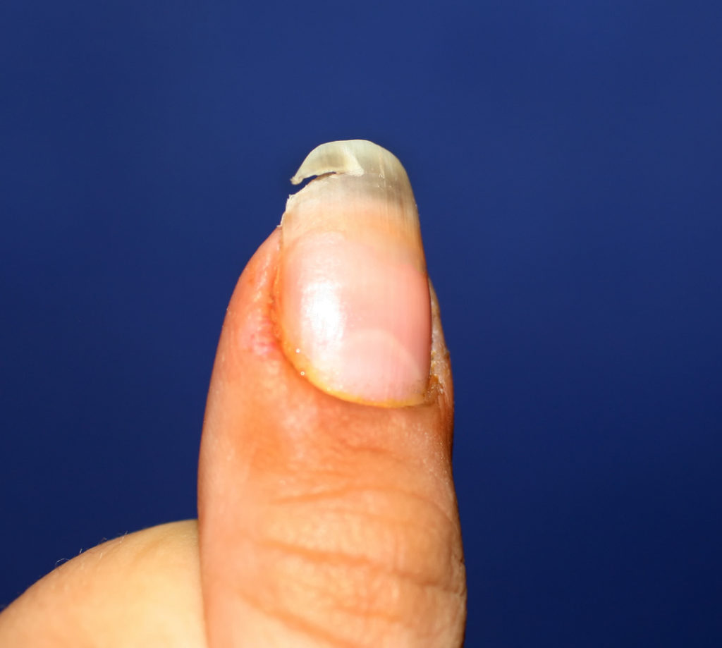 A broken nail. Lack of vitamins and calcium in the body.