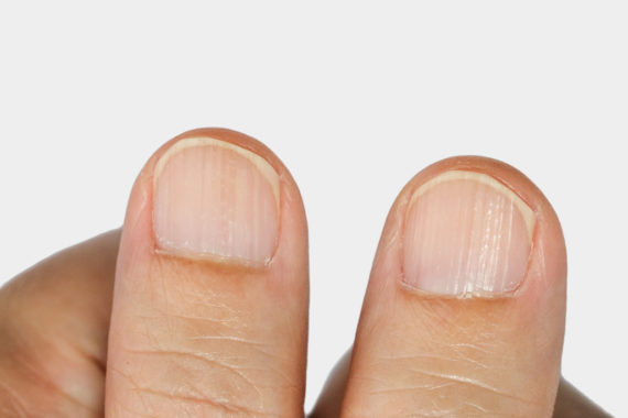 what-are-the-causes-of-ridges-in-fingernails