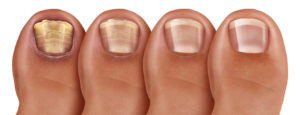 Fungal Nail Infection Recovery