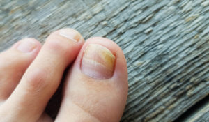 Close-up of a leg with a fungus on nails on a wooden background. Onycholysis: exfoliation of the nail from the nail bed.