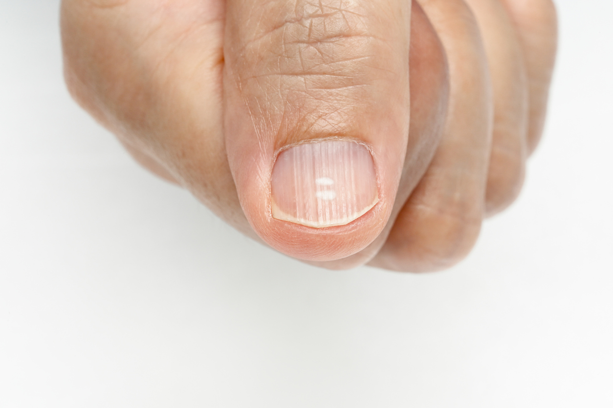What Do White Spots On Nails Mean?