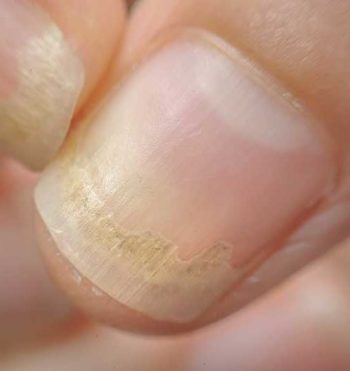 Your Nails Color or Texture Can Indicate Signs of Disease or Illness