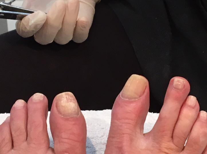How Can You Tell If You Have Toenail Fungus
