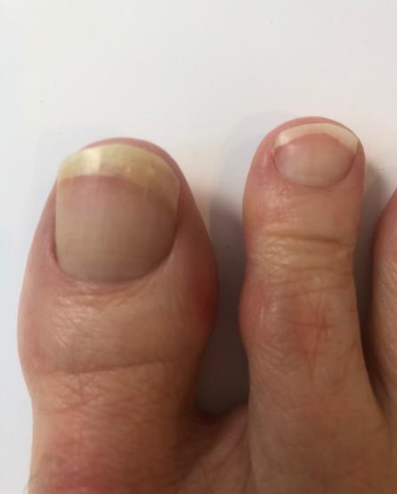 Can Toenail Fungus Spread To Other Areas of the Body? - Drs. Kline + Green